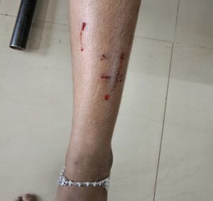 కోతుల బీభత్సం.. చిన్నారిపై దాడి